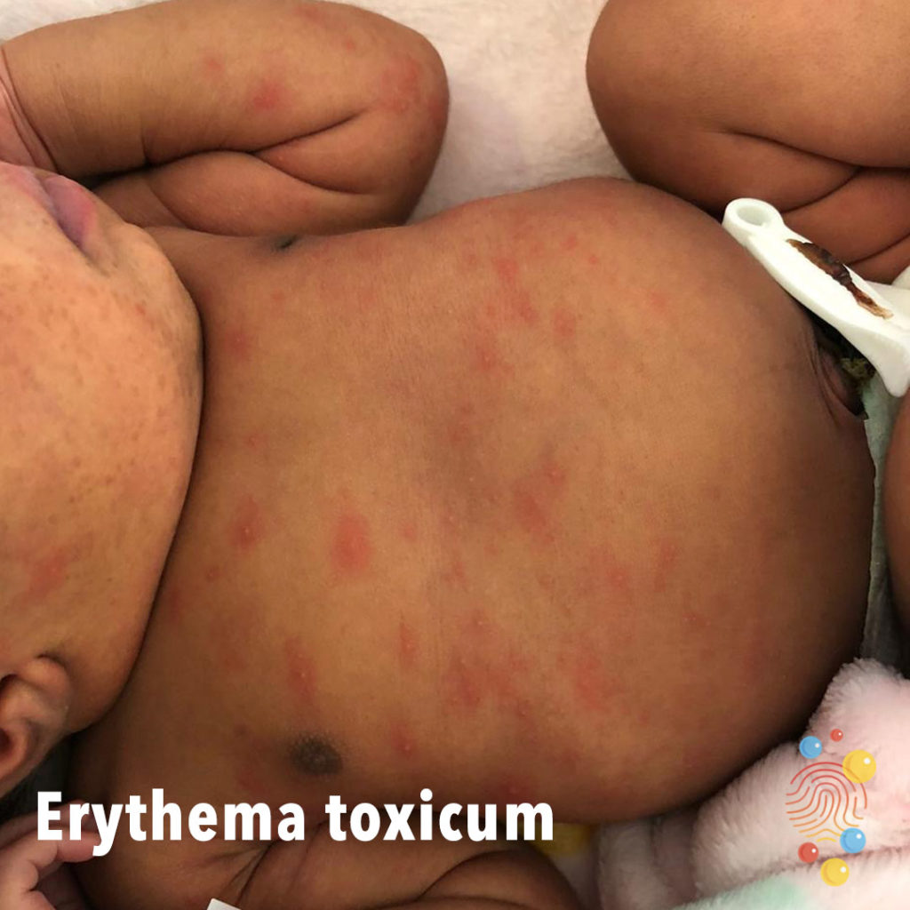 Baby with darker skin with Erythema toxicum rash on face, torso and arms