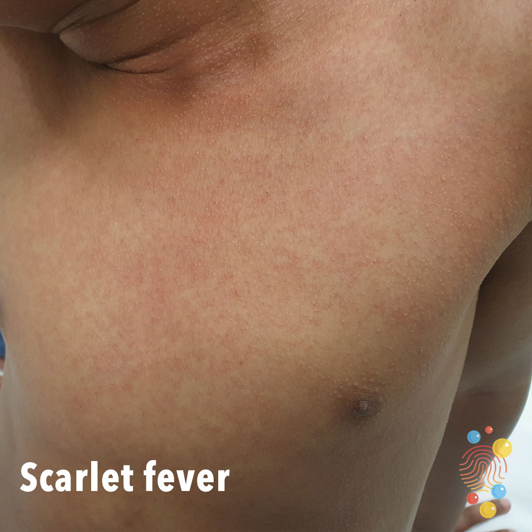 A picture showing the scarlet fever rash on darker skin