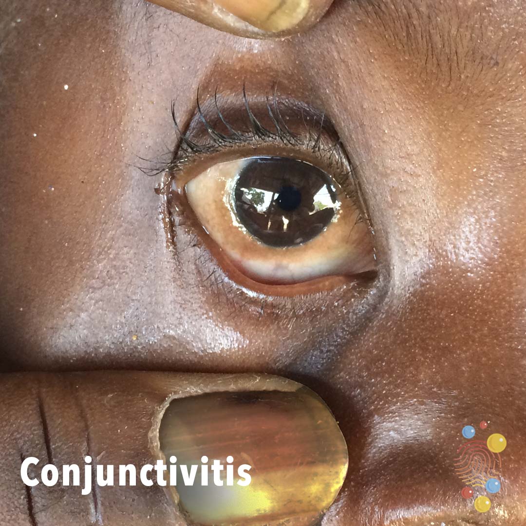 D116-conjunctivitis.jpg