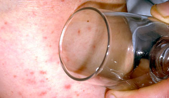 A visual depiction of the glass test, a glass pressed on a rash